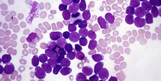 Scientists discover how to change human leukemia cells into harmless immune cells