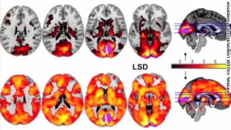 160413035437-effects-of-lsd-on-human-brain-curnow-intv-00003204-large-169