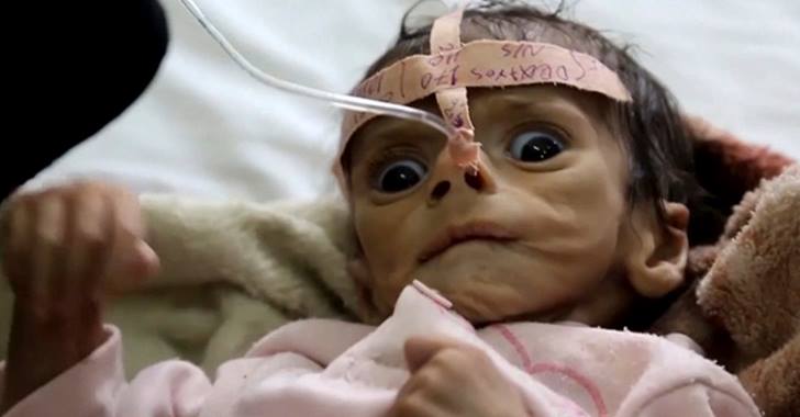 Media Silent As Saudi Arabia Devastates Yemen Into Famine