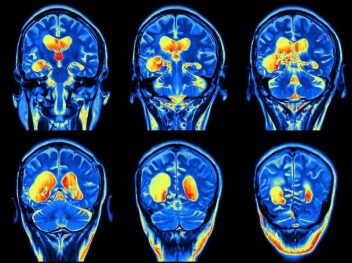 People With Mild COVID-19 May Experience ‘Serious’ Brain Disorders: UK Neurologists