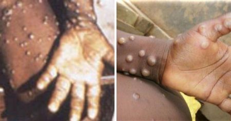 CDC Scrambles After Rare Case of Monkeypox Turns Up in Texas